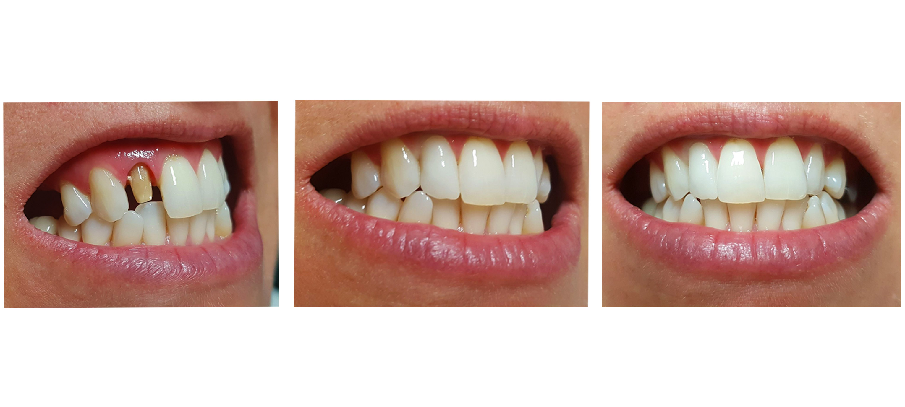 Corona in zirconia monolitica